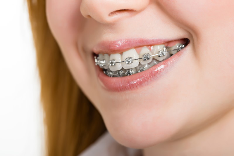 انواع روش های ارتودنسی دندان / مزایا و معایب آن