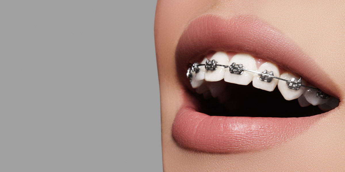 انواع روش های ارتودنسی دندان / مزایا و معایب آن