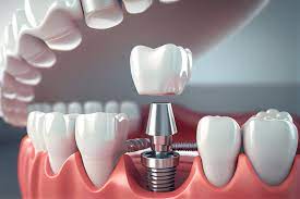 ایمپلنت دندان در کرج / قیمت ایمپلنت دندان در کرج