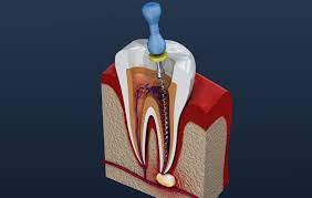 به عصب رسیدن دندان چیست؟
