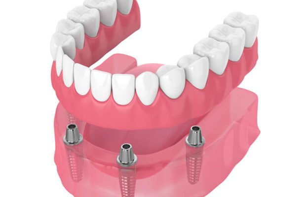پروتز دندان چیست؟ انواع پروتز دندان و هزینه آن
