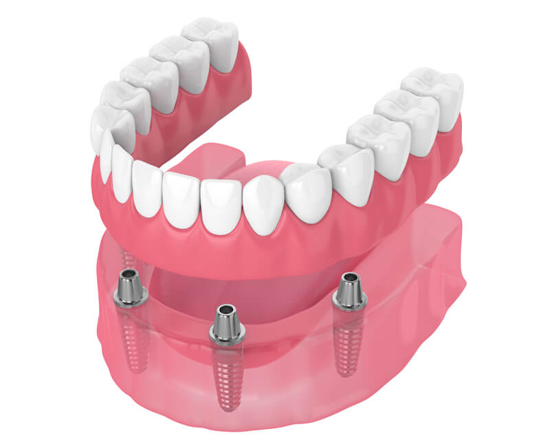 پروتز دندان چیست؟ انواع پروتز دندان و هزینه آن