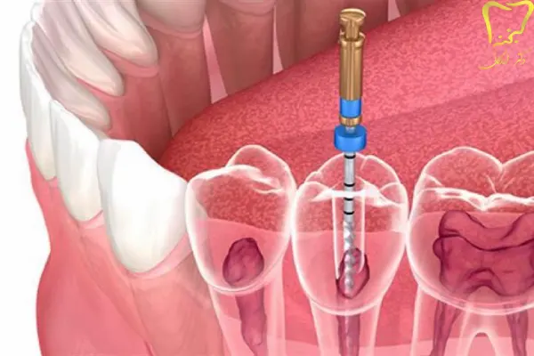 علائم نیاز به درمان ریشه دندان