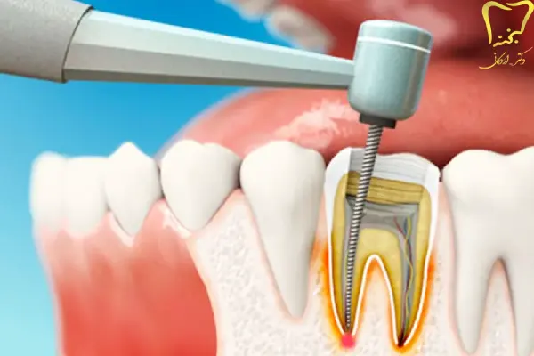 درمان ریشه دندان چیست؟