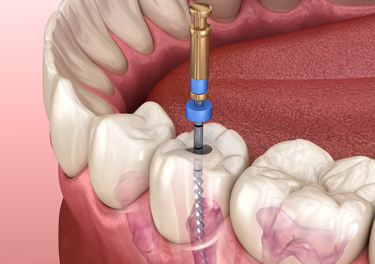 درمان ریشه دندان چیست و چگونه انجام میشود ؟