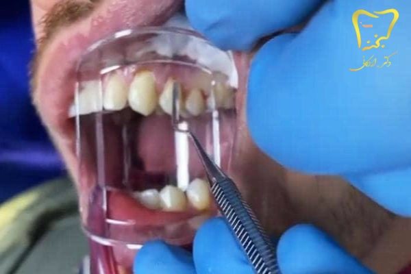ایمپلنت و کاشت دندان