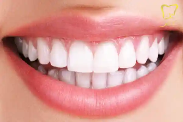 اصلاح طرح لبخند با کامپوزیت دندان