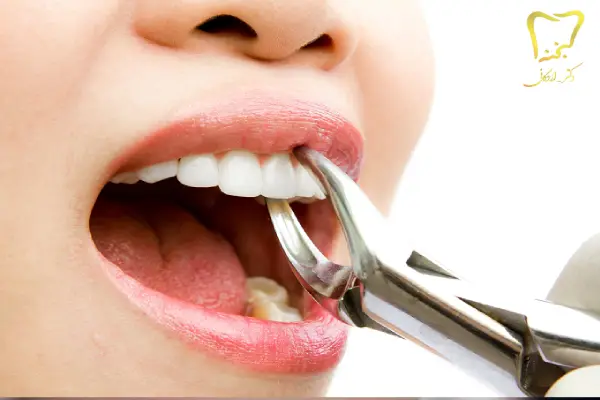 جراحی دندان عقل نهفته تخصصی