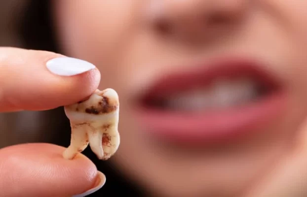 دلایل جراحی دندان عقل چیست؟