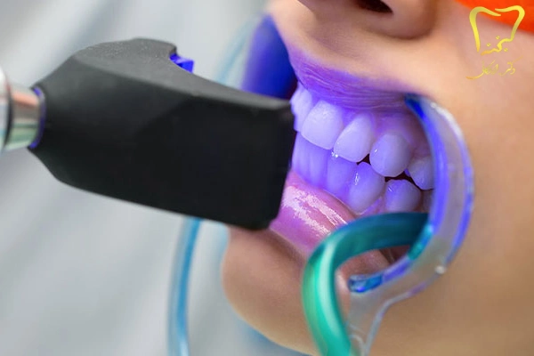 روش های جرمگیری دندان