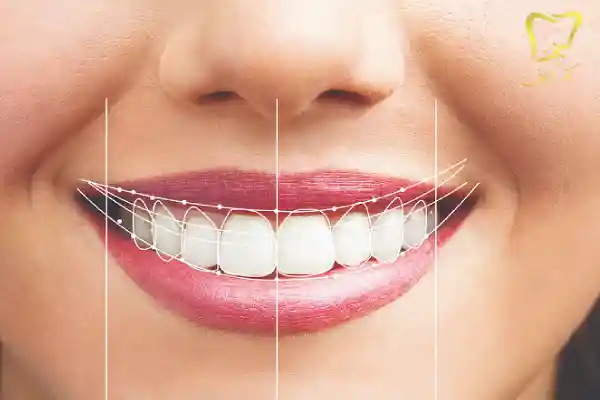 روکش دندان برای اصلاح طرح لبخند