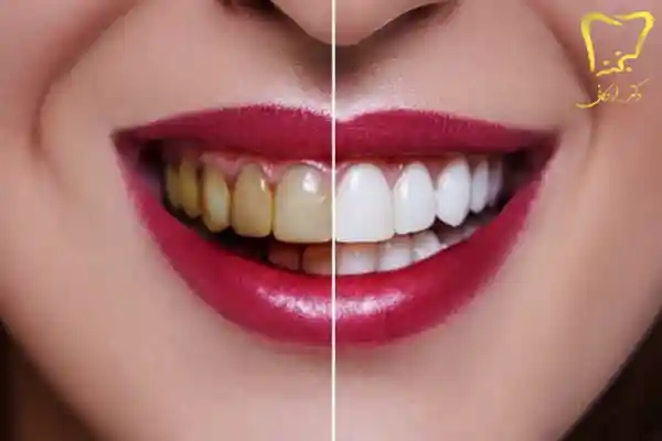 فرق کامپوزیت و لمینت دندان