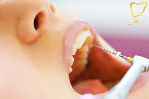 متخصص درمان ریشه دندان در کرج