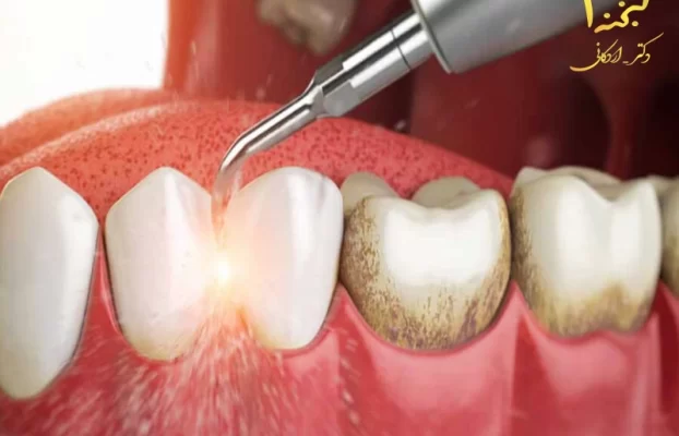 جرم‌ گیری دندان چیست و چگونه انجام می‌شود؟