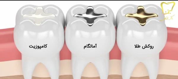 انواع پر کردن دندان