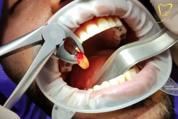 هزینه دندانپزشکی بدون درد در کرج