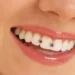 پوسیدگی-دندان-چیست؟