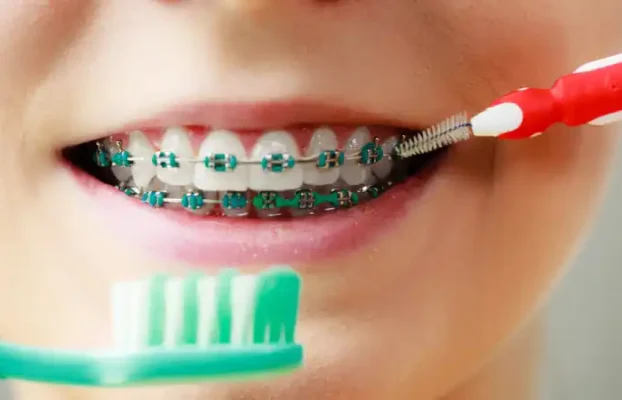 بهترین خمیر دندان ارتودنسی چیست؟