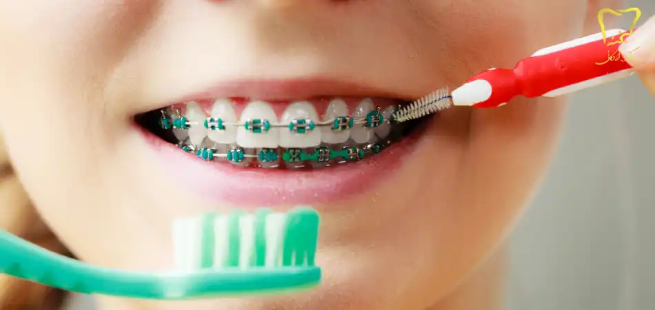 بهترین خمیر دندان ارتودنسی چیست؟