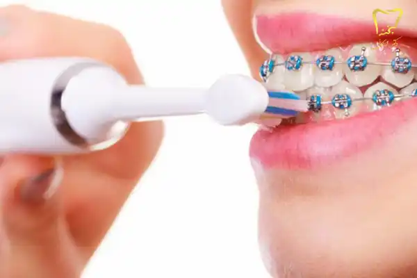 بهترین خمیر دندان ارتودنسی