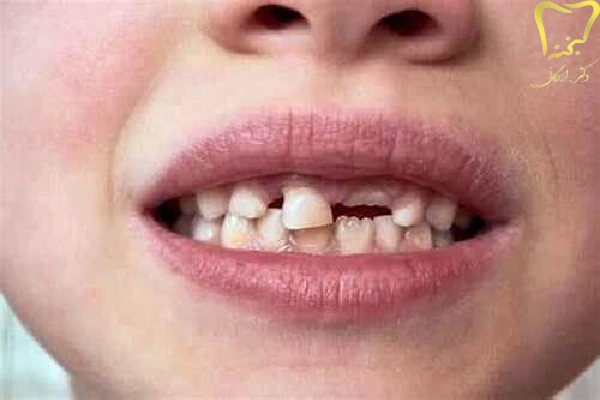 شکستگی دندان چیست؟