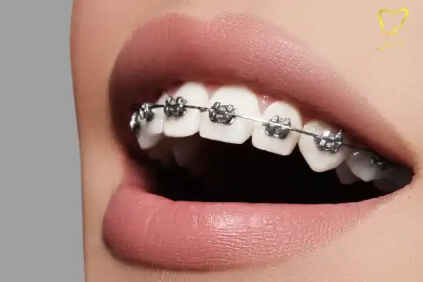 مزایای استفاده از خمیر دندان ارتودنسی