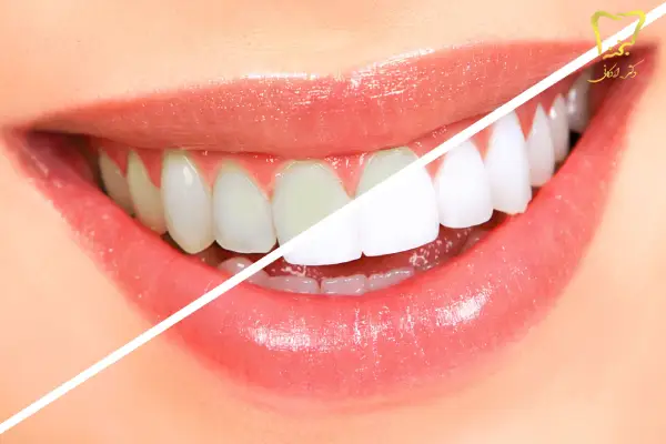 بلچینگ دندان چیست؟