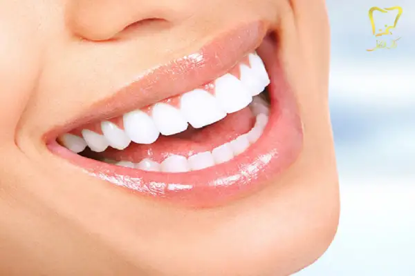 هزینه بلچینگ دندان در کرج