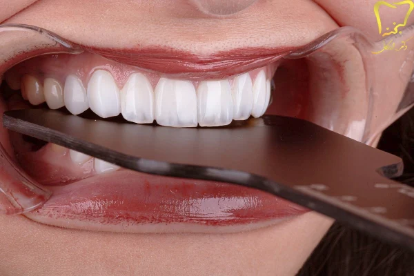 راهکارهای قبل از انجام لمینت دندان