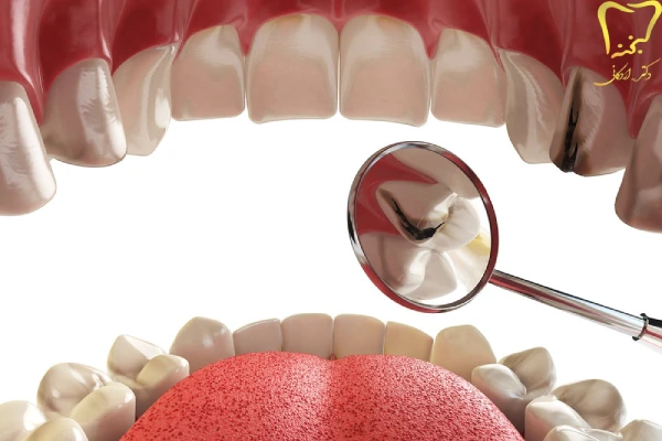 علائم فرسایش مینای دندان