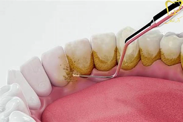 علت فرسایش مینای دندان