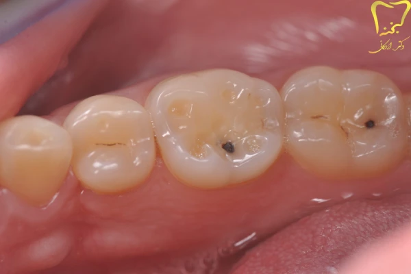 عوارض فرسایش دندان