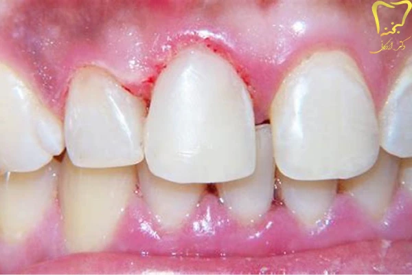 فرسایش مینای دندان