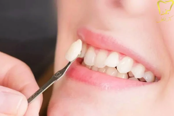 نکات قبل از انجام لمینت دندان