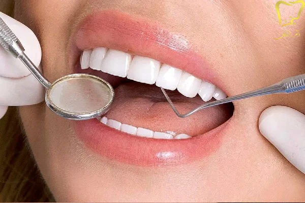 نکات مهم قبل از انجام لمینت دندان