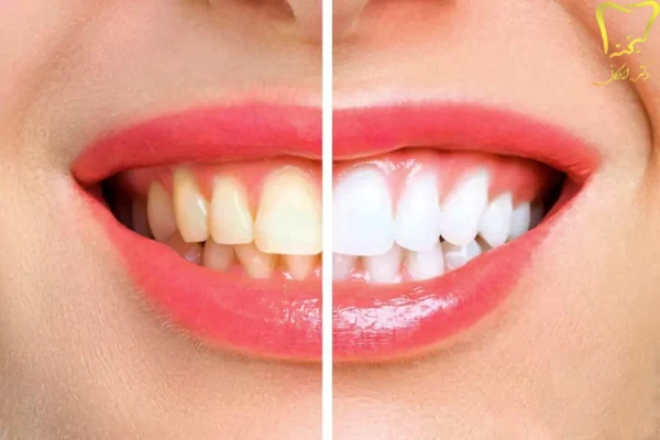 پیش از انجام لمینت دندان