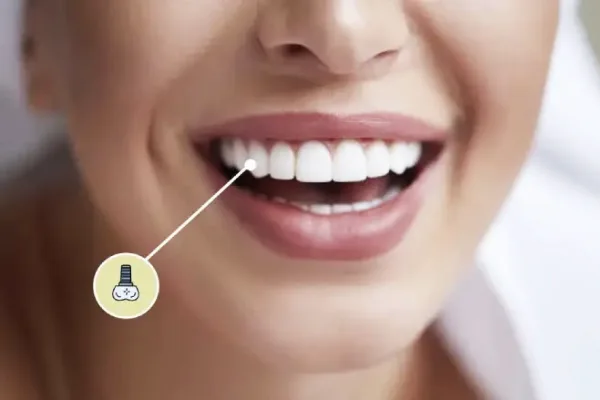 ایمپلنت دندانی