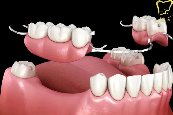 پروتز دندان متحرک