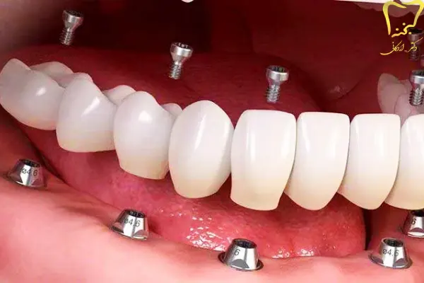 انواع ایمپلنت دندان در کرج