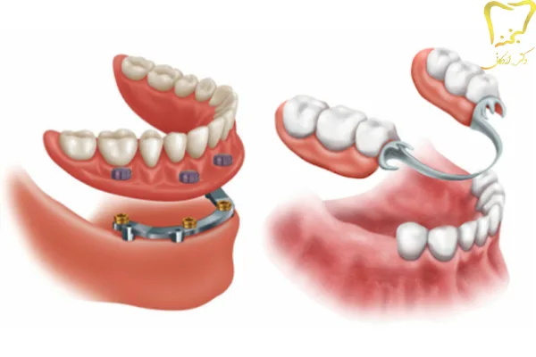 انواع پروتزهای دندانی متحرک