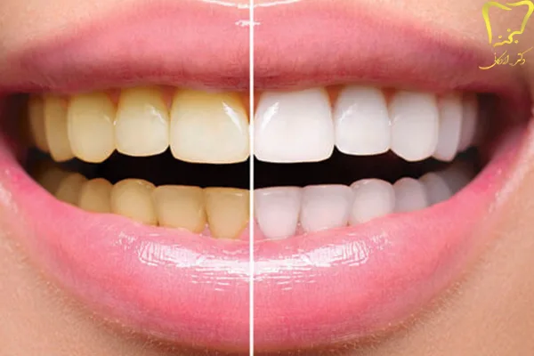 انواع خدمات زیبایی دندان