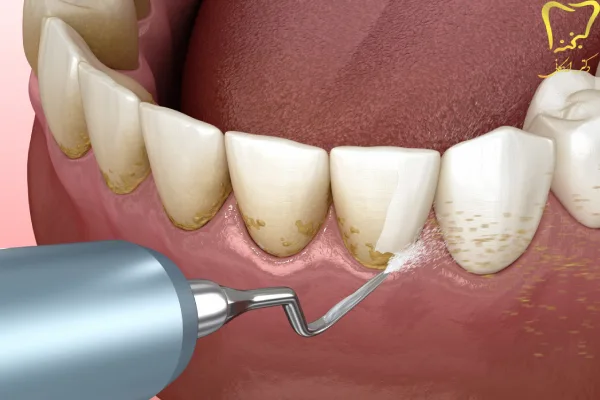 جرم گیری دندان