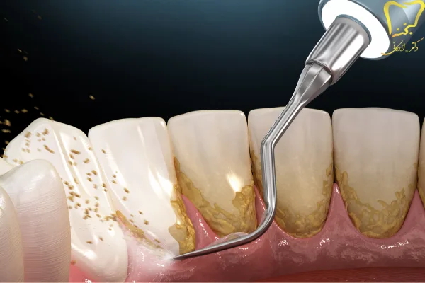 مراقبت های بعد از جرم گیری دندان 