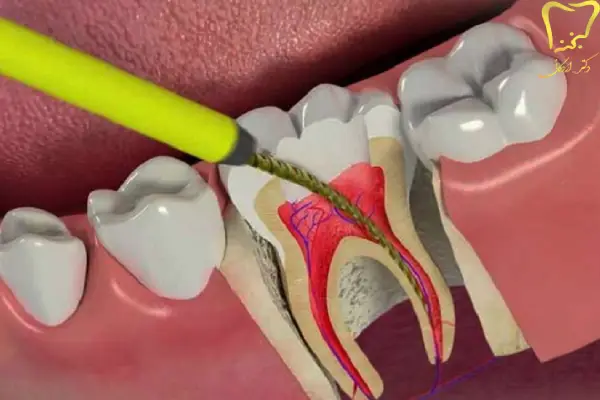 روش های عصب کشی دندان کودکان 