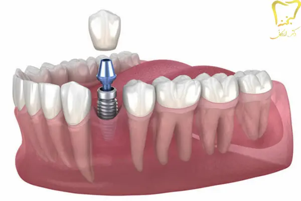 ایمپلنت تک دندانی