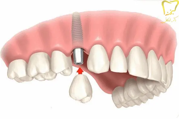 مراحل کاشت ایمپلنت تک دندانی