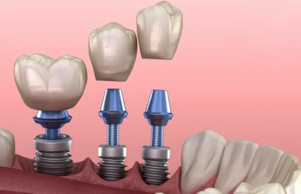 بهترین زمان کاشت ایمپلنت بعد از کشیدن دندان