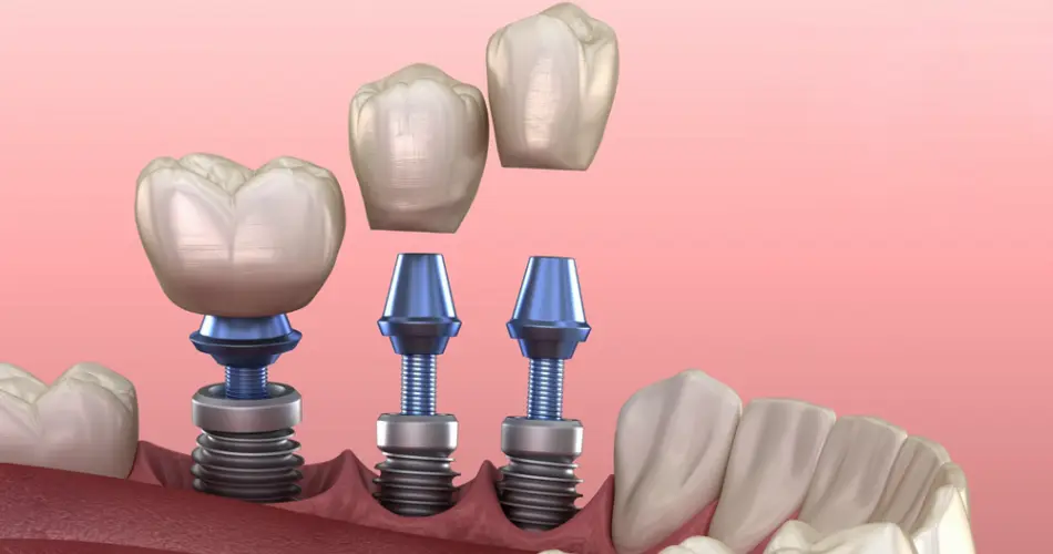 بهترین زمان کاشت ایمپلنت بعد از کشیدن دندان