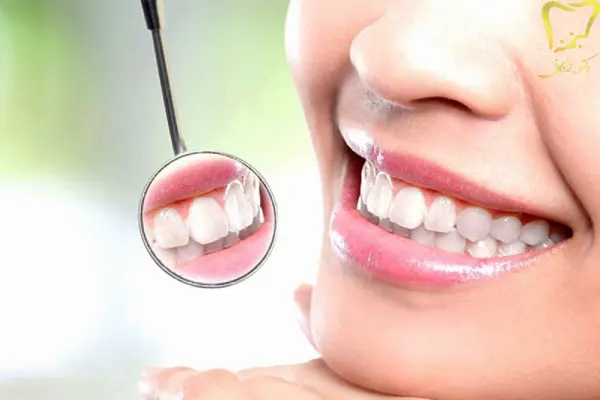 سفیدی دندان‌ها با بلیچینگ زیباتر است یا لمینت؟
