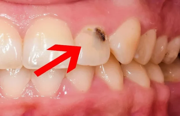 علائم پوسیدگی دندان را بشناسیم